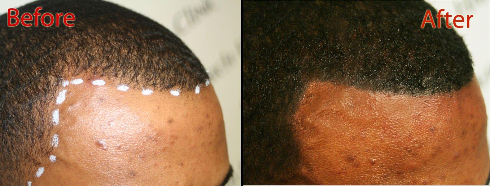 DermiMatch LLC B - Scalp micropigmentation pigments by DermMicro (B)