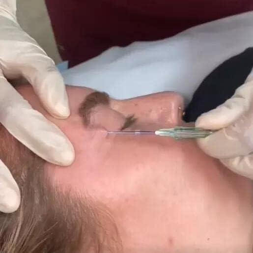 MatYas 20Pcs Pdo Cog Threads 4D 21G60mm for Fox Eye Lifting, W-Type, Barb Cog Threads