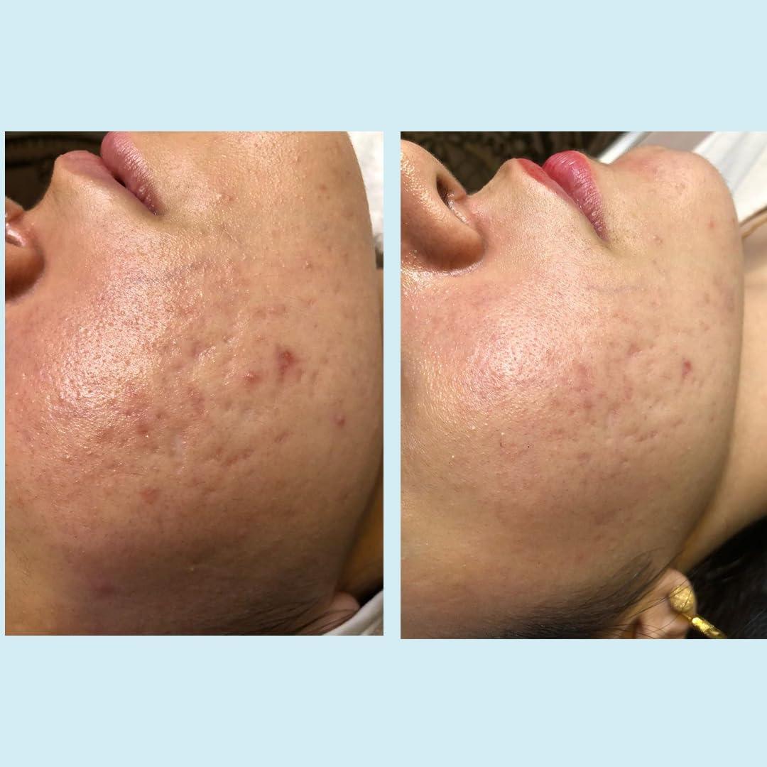 Perfect Image Salicylic Gel Chemical Peel - Enhanced with Green Tea Extract and Tea Tree Oil (20% Strength)