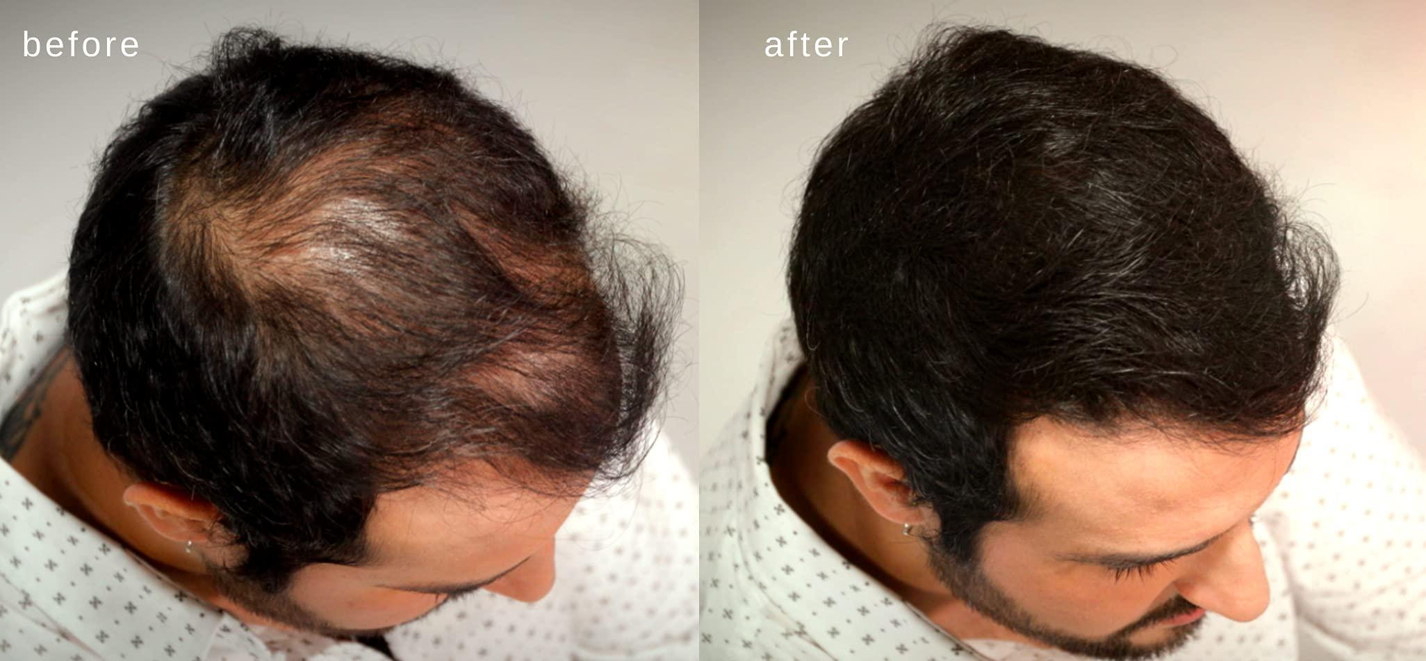 MAXX PRO-SERIES MAXX PRO-SERIES Volumizing Hair Fibers with real Keratin for Thinning Hair/Hair Loss – Dermatologist Tested and Certified Hypoallergenic - 60 days + supply - Multiple Colors Available (Dark Brown)