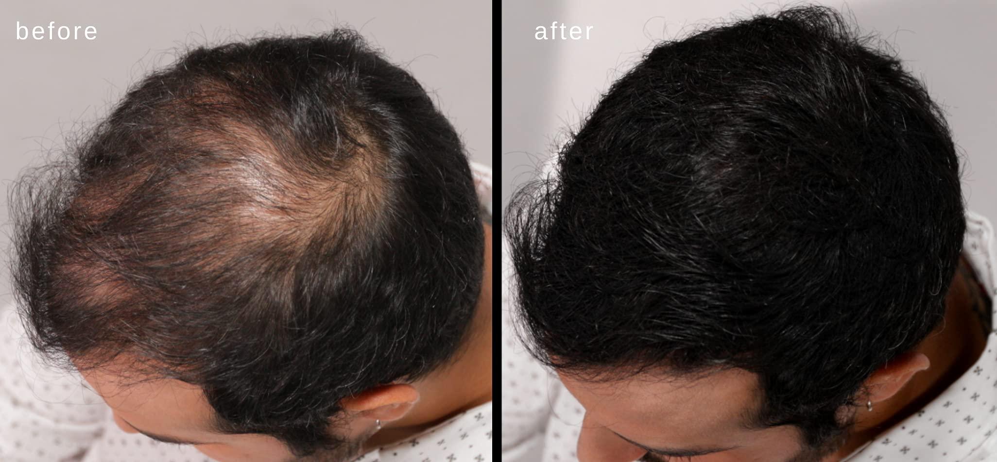 LUXE Professional LUXE Hair Thickening Fibers - CONFIDENCE IN A JAR – 2 Months+ Supply! – Hypoallergenic, Dermatologist Tested – Multiple Colors Available (Dark Brown)