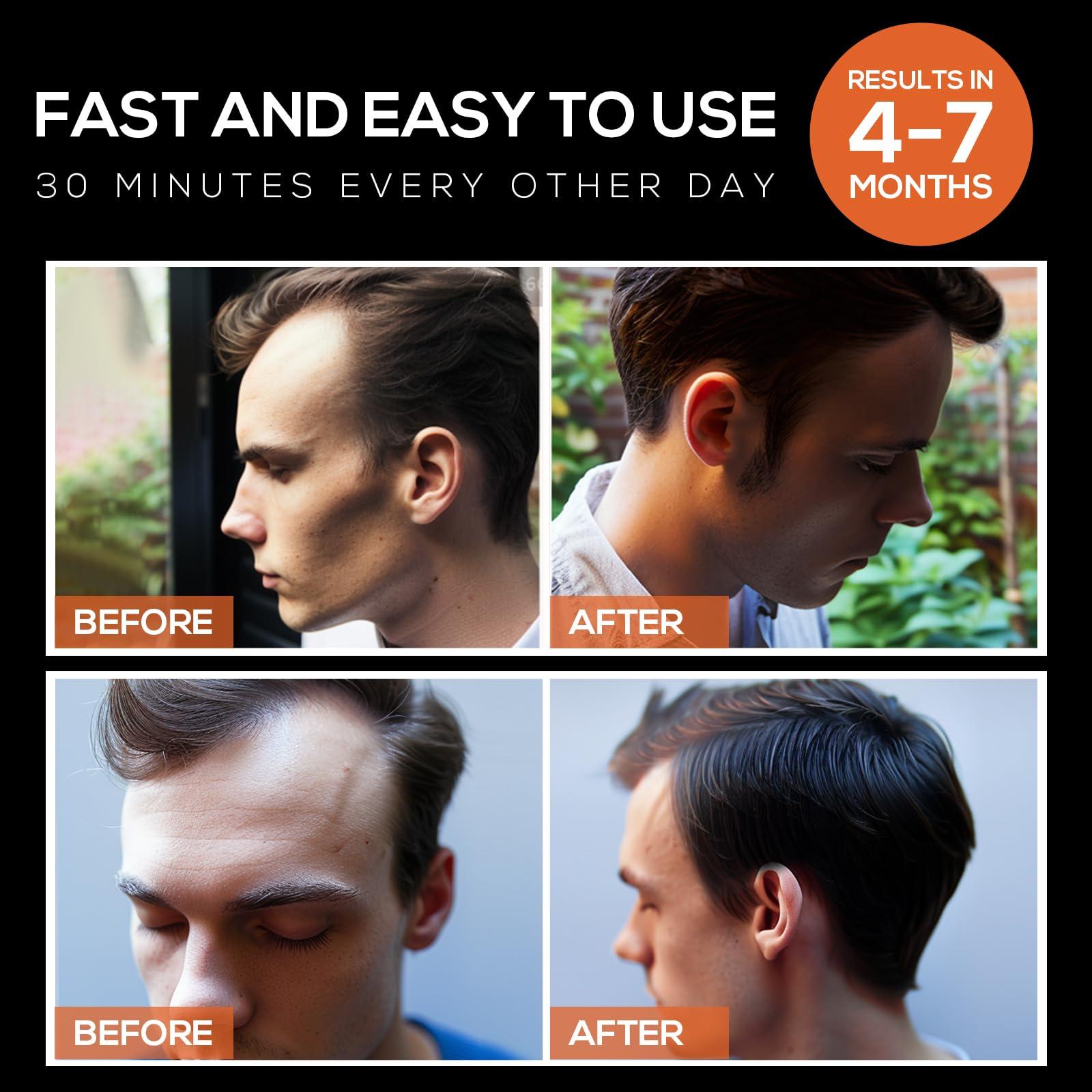 WINTER PLUM Laser Hair Growth Cap,Laser Therapy Cap Hair Growth Device Cap for Hair Loss Hair Loss Treatments for Men & Women Red Light Therapy Cap