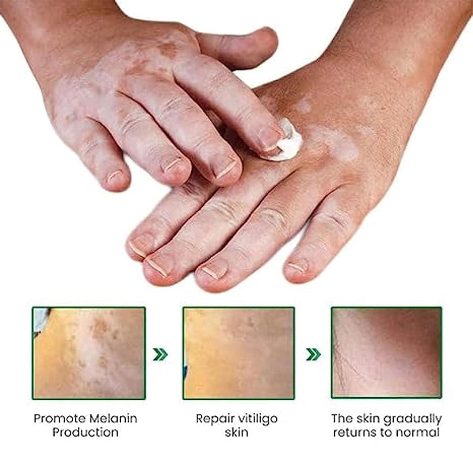 EXQST Vitiligo Fix Revitalize Elixir,2023 New Vitiligo Treatment Cream,Vitiligo Soothing Cream,Moisturizer Cream For Skin Vitiligo,Vitiligo Care Cream For Reduce White Spot