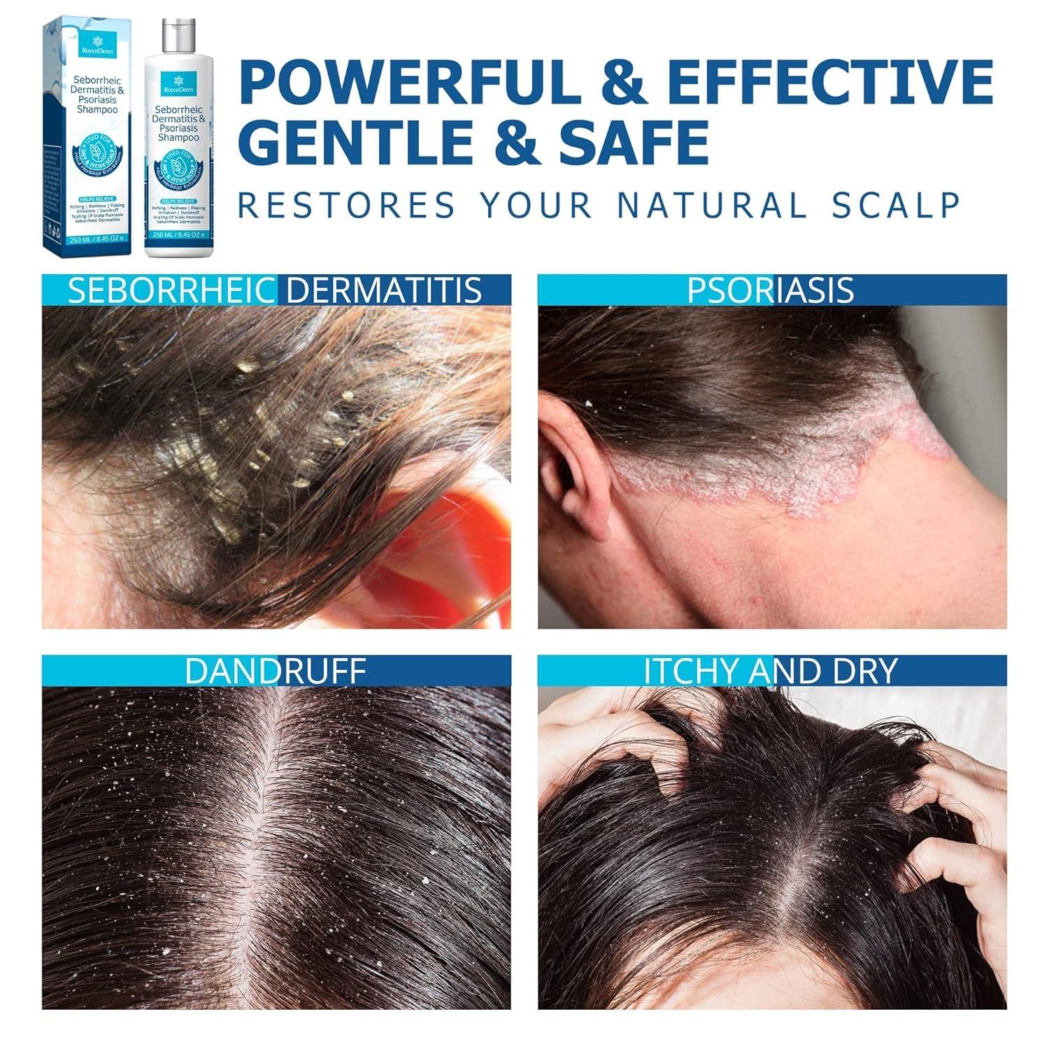 Roycederm Roycederm Psoriasis Shampoo, Seborrheic Dermatitis Shampoo, Folliculitis Shampoo, Dandruff Shampoo, Scalp Psoriasis & Seborrheic Dermatitis Treatment, Dry Itchy Scalp Treatment
