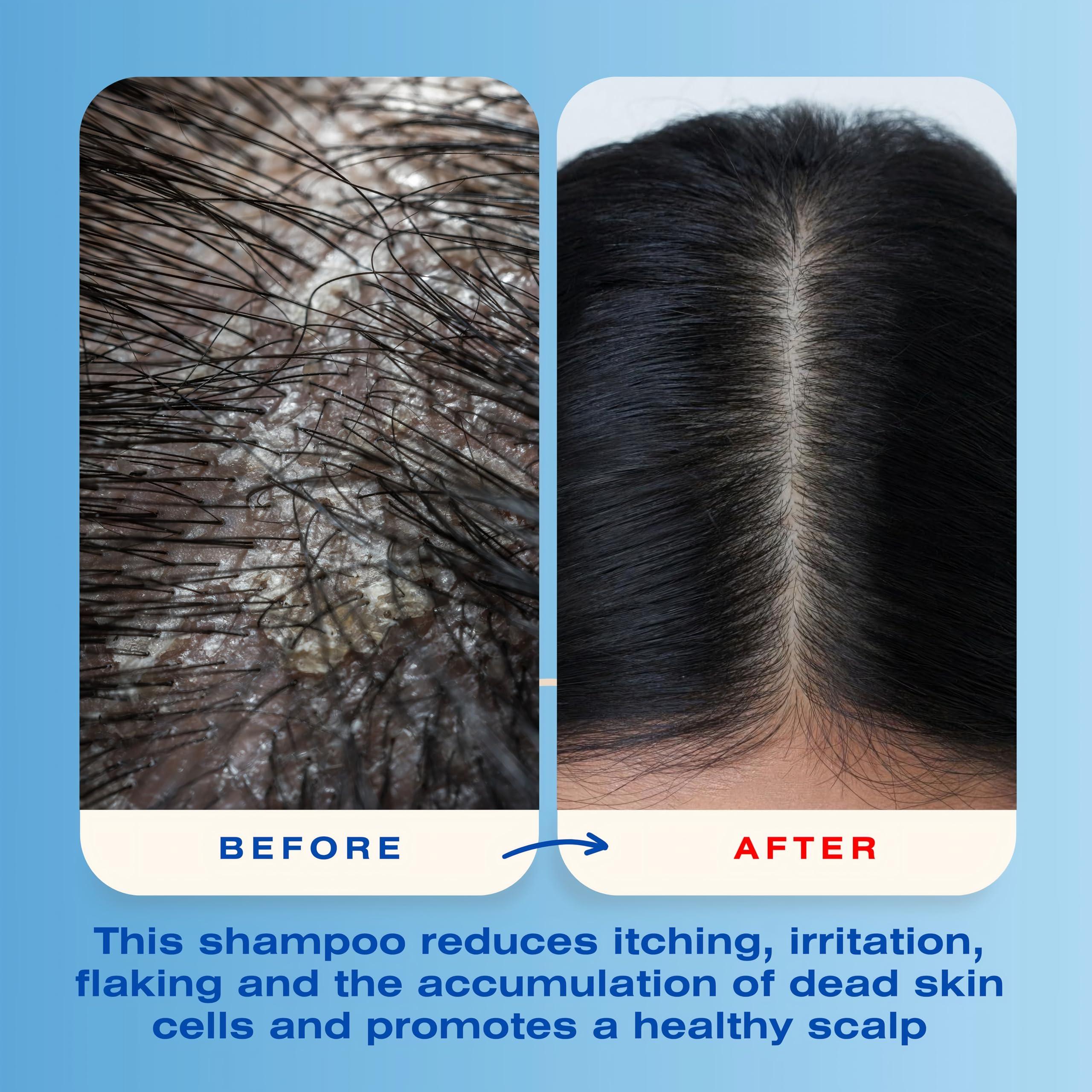 Mediceuticals Mediceuticals X-Folate Shampoo Anti Dandruff Shampoo for Women and Men Persistent Dandruff Control For Scaly, Flaky Scalp and Scalp Buildup - Reduces Itching - Large 33.8 oz (1 Liter)