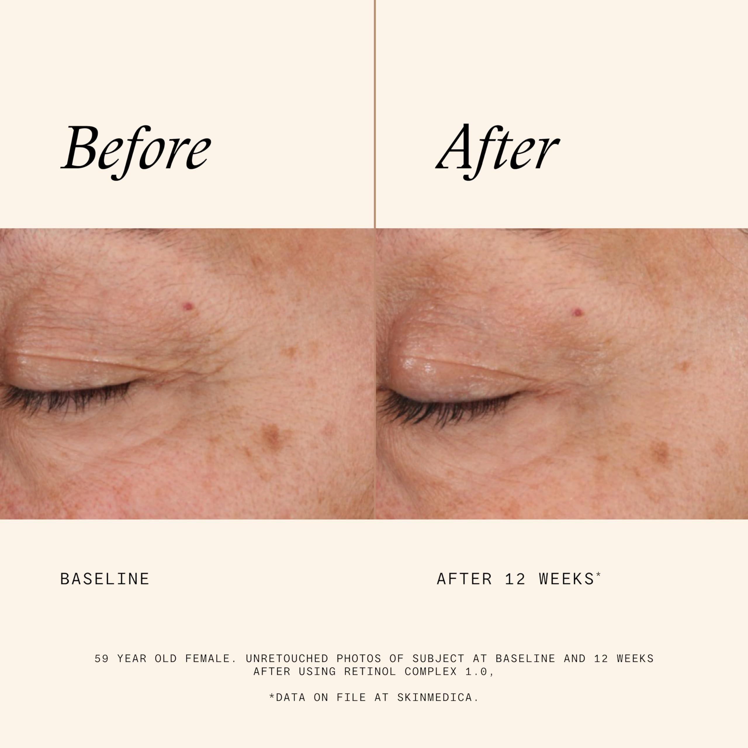 SkinMedica SkinMedica Retinol 1.0 Complex - Retinol Serum for Face, Age-Defying Advanced Retinol Cream That Renews Skin and Diminishes the Appearance of Fine Lines and Wrinkles, 1 Fl Oz