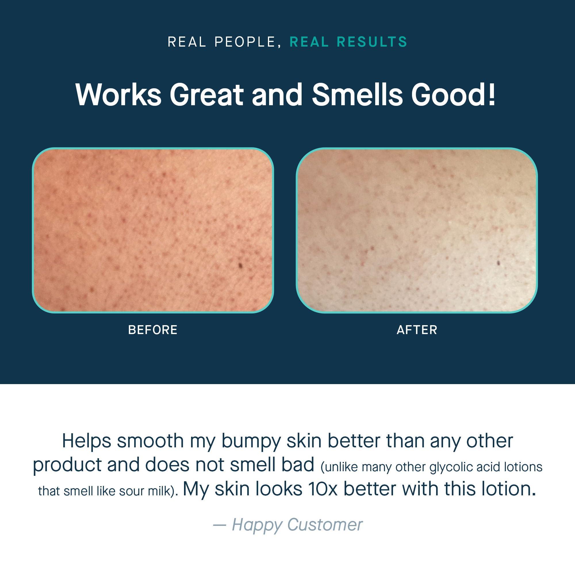 SLMD SLMD by Dr. Pimple Popper | Glycolic Acid Body Lotion | Exfoliating Glycolic Acid Lotion Body for Rough, Bumpy Skin and Skin Prone to KP, Ingrown Hairs, Shaving Bumps | 10% AHA - 6 fl. oz.