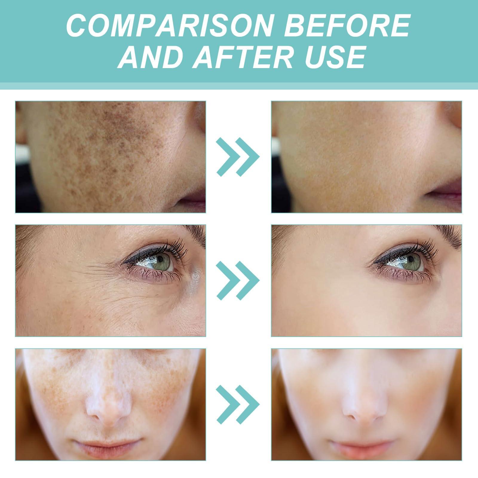 BEROZA 2Pcs(Set box 60G) Crema Para Las Manchas De La Cara, Crema Reparadora Para Manchas Oscuras, Crema para manchas oscuras en la cara