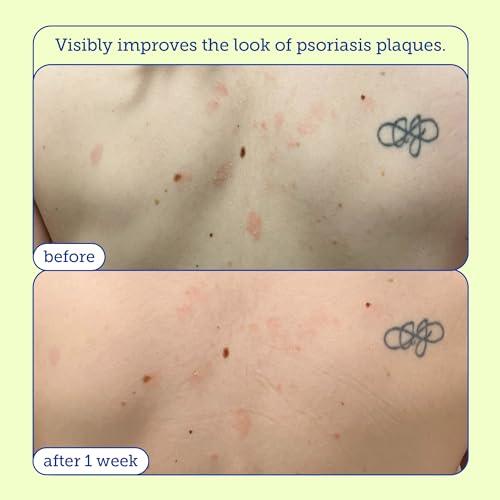 Skinfix Skinfix KP+ Psoriasis Smoothing Treatment Body Lotion 5.07 oz / 150 mL