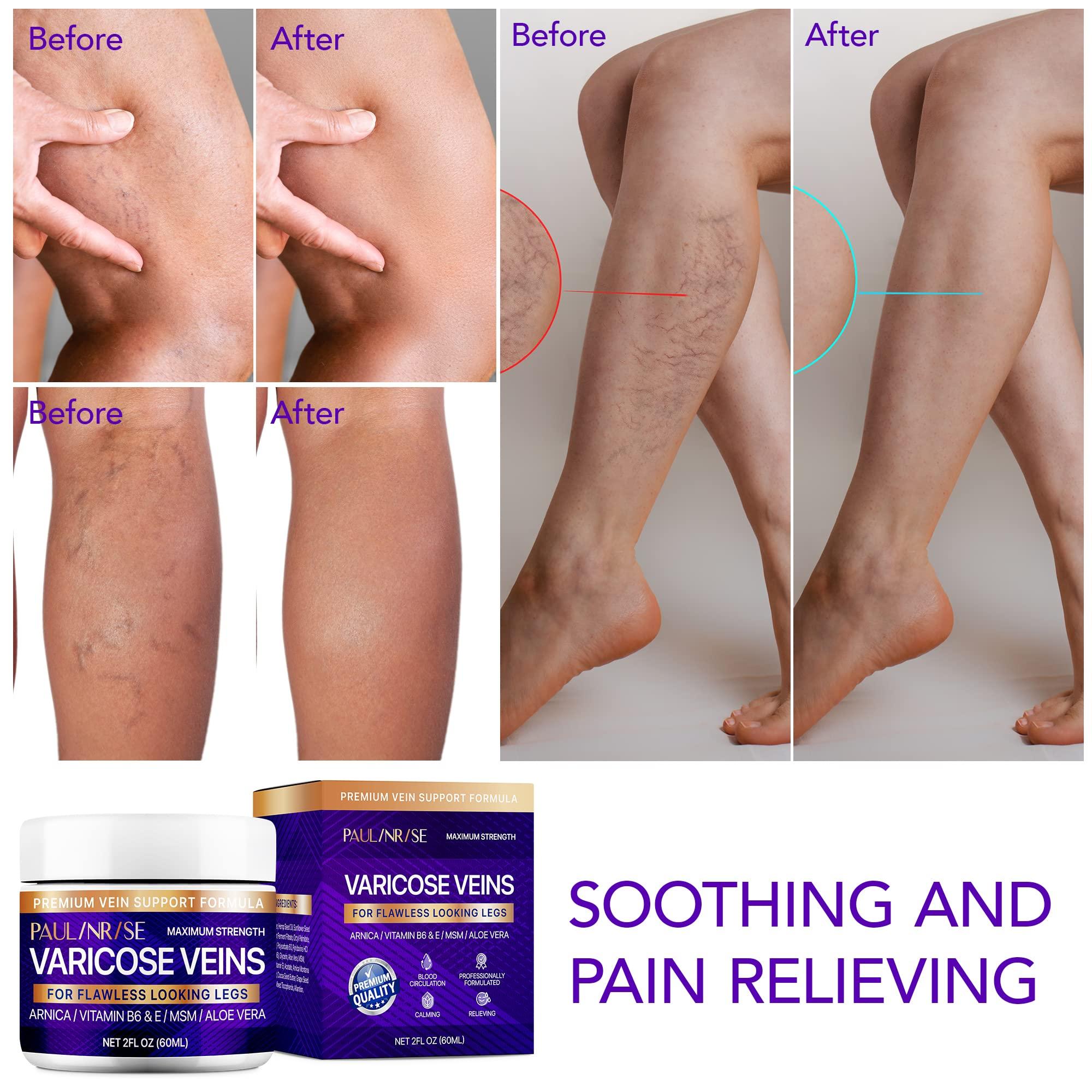 PAULINRISE PAULINRISE Varicose Vein Cream for Legs - Improves Blood Circulation, Reduces Spider Veins and Heaviness, 2 Oz