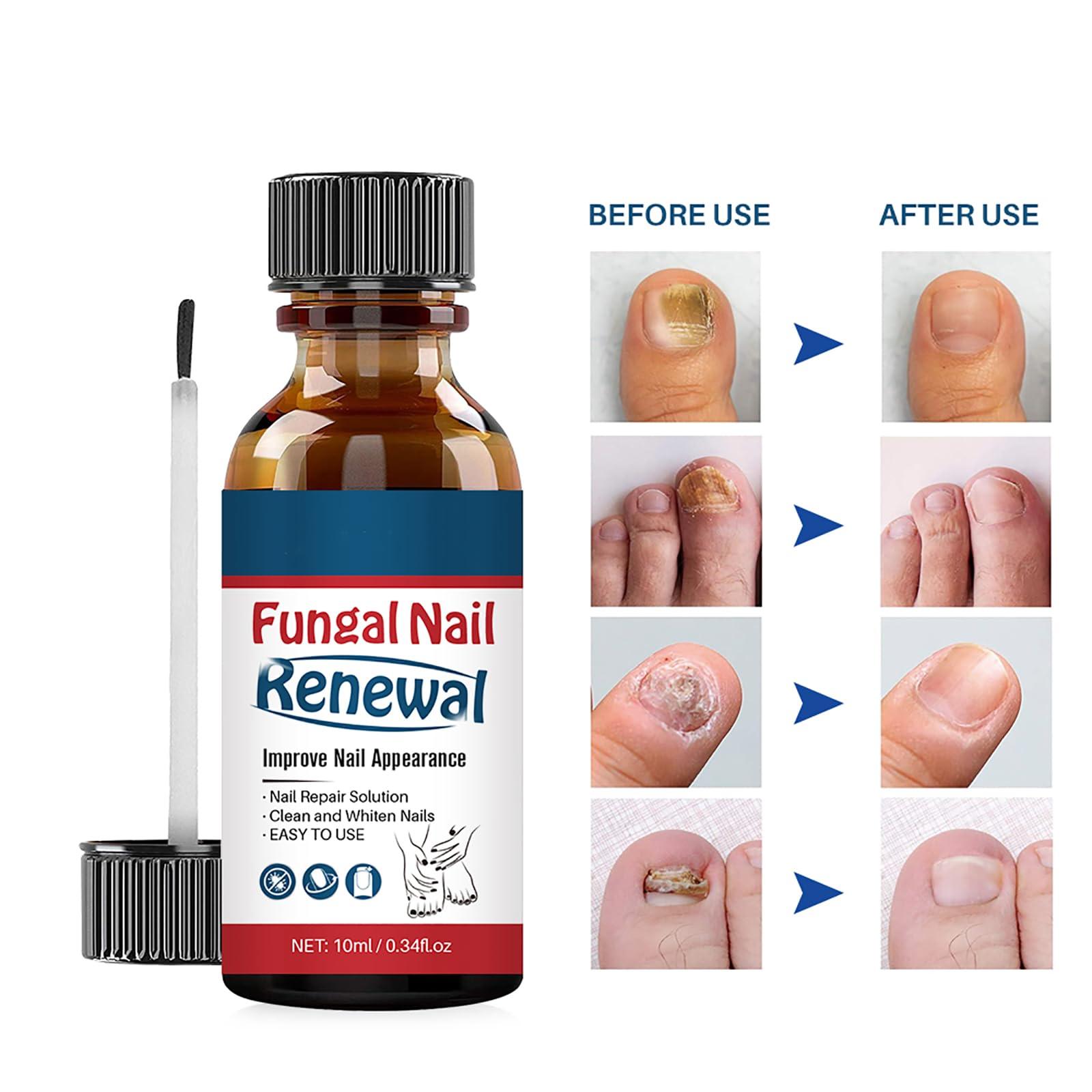 Easilydays Easilydays Nail Repair Essnce Liquid, Fingernail and Toenail Repair, Fix & Renew Damaged, Broken, Cracked & Discolored Nails, Reduce Nail Thickening, Strengthen Nails for Beautiful Nail