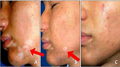 Fiico Melgain Lotion for Vitiligo/White Patches: Decapeptide : Stimulates Pigmentation 10ml (Pack OF 2) - With Express Shipping