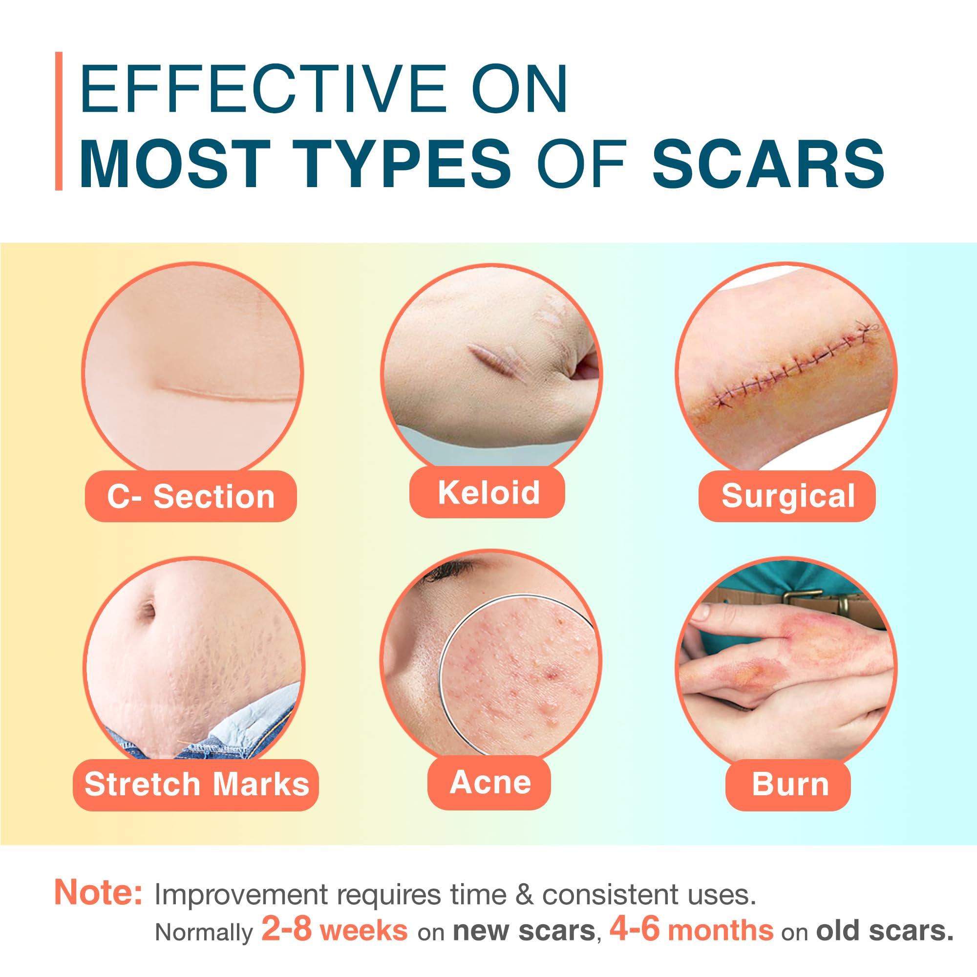MEDLOT MEDLOT Silicone Scar Sheets, 1.5 x 156 Medical Silicone Scar Tape Roll, Reusable Scar Strips for Surgical, C-Section, Keloid Bump, Stretch Marks, Acne, Hypertrophic Scar Treatment