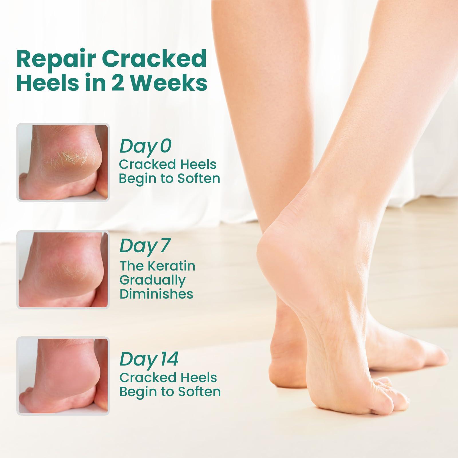 Welnove Welnove Moisturizing Heel Socks - 2 Pairs Aloe Vera Extract Infused Gel Lining for Dry Feet - Cracked Heel Repair Treatment - Cotton Socks for Women Men Foot Care (Pink, Extra Large)