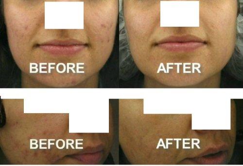 Kendal Kendal 3 in 1 Professional Diamond Microdermabrasion Machine