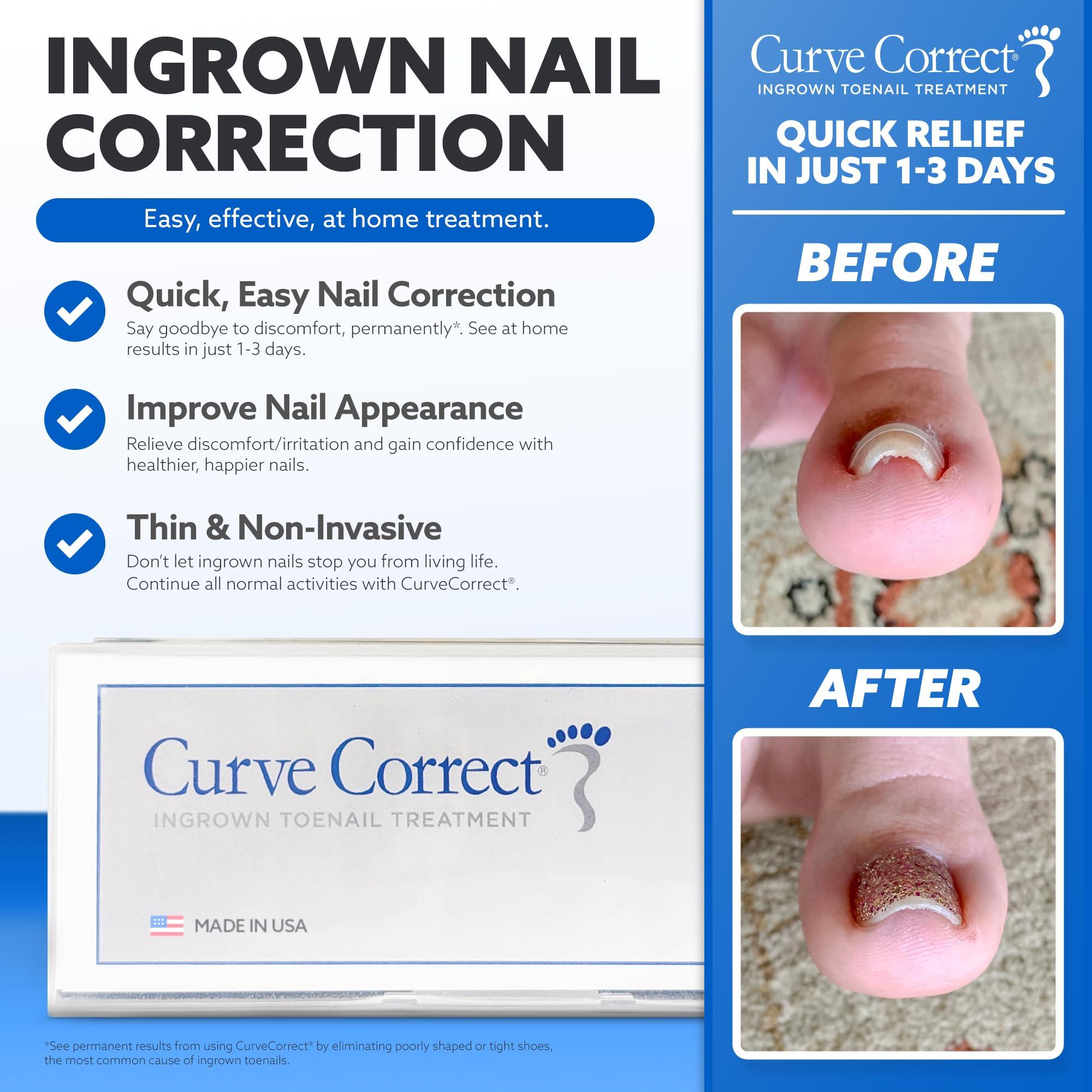 CurveCorrect CurveCorrect Ingrown Toenail Home Treatment | Ingrown toenail Correction kit, Includes Ten Standard Big Toe Nail Braces.