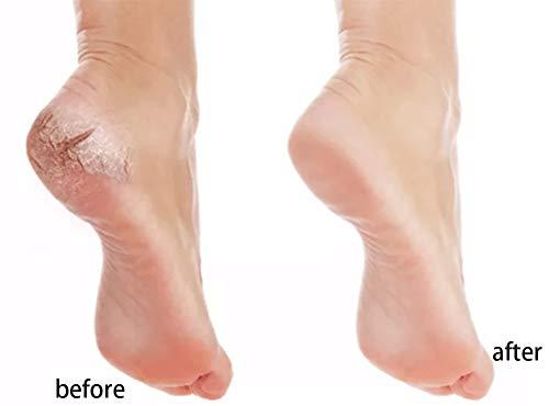 BesYouSel 8 in 1 Foot File Kit Professional Pedicure Foot Rub Tool, Colossal Foot Dead Skin Remover Foot Scrub Care Tool for Feet, Callus Remover and Pedicure Exfoliator Tool for Women Men Gift, Green