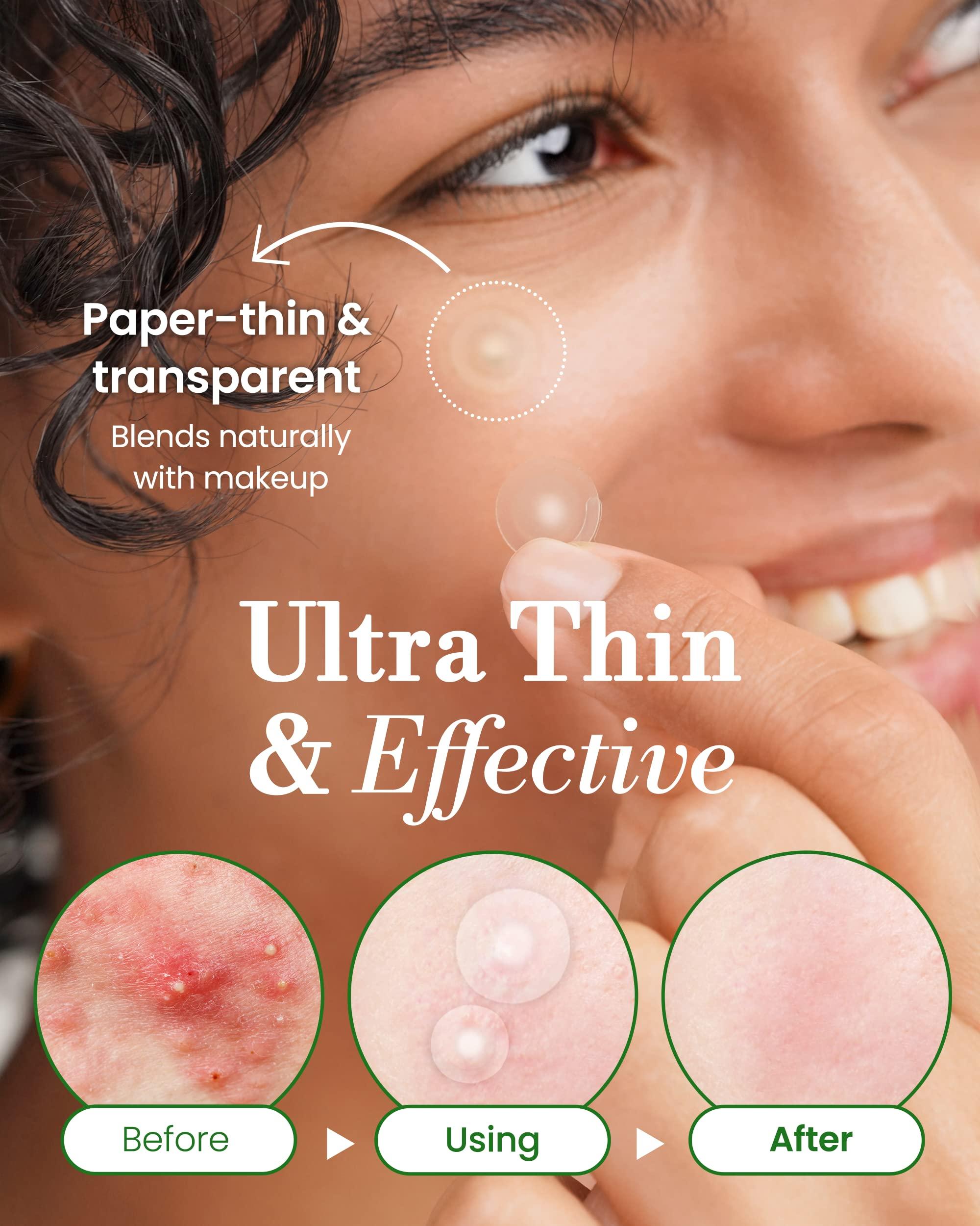 Troubless Troubless Invisible Pimple Spot Patch - Classic, Hydrocolloid Acne Patches for Face | Ultra Thin Acne Patches with Easy Peel Handle | Overnight Pimple Patches | 2 Sizes, 96 Count (Pack of 1)