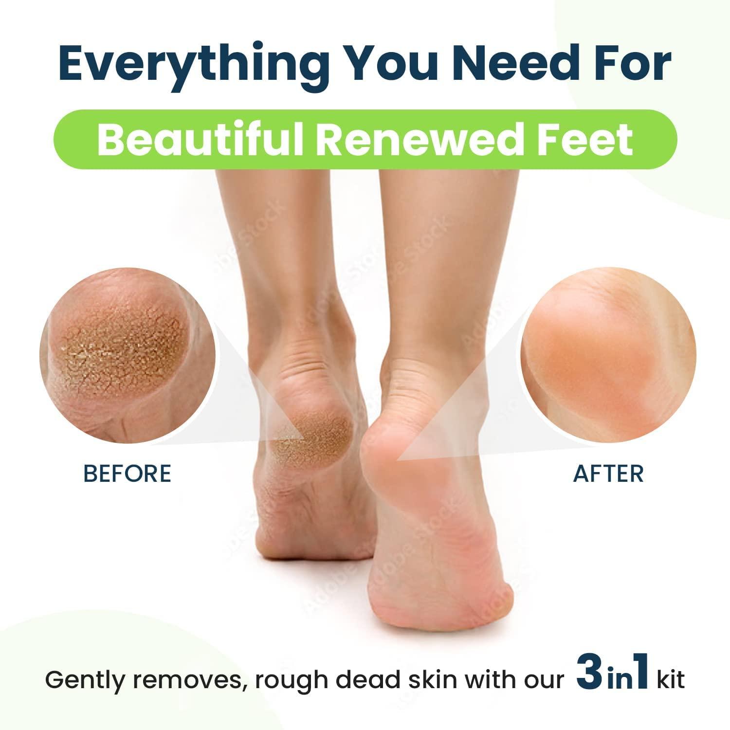 FOOT CURE Tea Tree Oil Foot Soak with Epsom Salt Callus Remover for Feet with Extra Strength Gel & Foot Pumice Stone Set - Easy Way to Remove Hard Calluses & Dead Skin Build-Up - Professional at-Home Foot Care