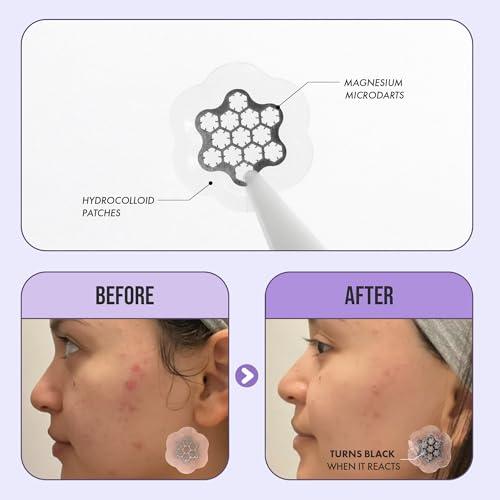 FreeGo Deep Blemish Microdarts | Pimple Patch | Cystic Acne | Fast-Acting | Quick Calming | 99.9% Pure Magnesium | Madecassic Acid | Tea Tree | Eucalyptus Leaf | Hydrocolloid Spot Care