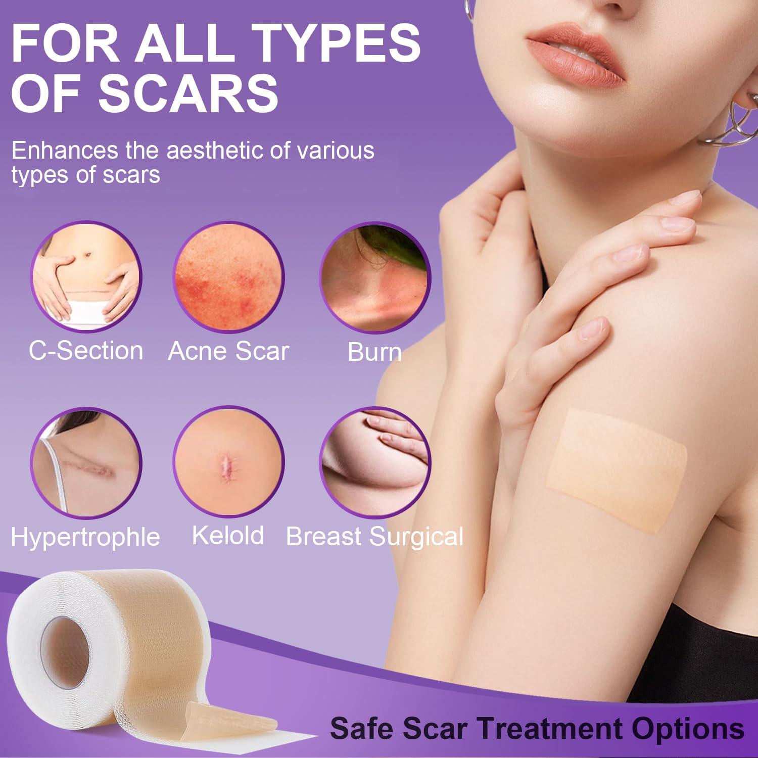 Mitgary Silicone Scar Sheets, Medical Grade Silicone Scar Tape (1.6\" x 120\"), Professional Scar Removal Treatment, Reusable, for Healing Keloids, Surgeries Scars, C-sections, and Burns