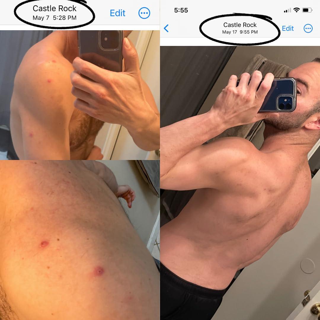 Bacne Bar Bacne Bar: All Natural Body Acne Soap with Charcoal, Pumice, Tea Tree Oil & Vitamin E to Get Rid of Bacne Fast, Back Acne Treatment as part of a Cleark Skin Routine (3)