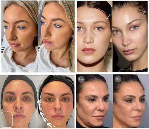 MatYas Pdo Cog 6D Threads 19G100MM, W-Type, 360R Bidirection Cog for Face Lift, 20pcs