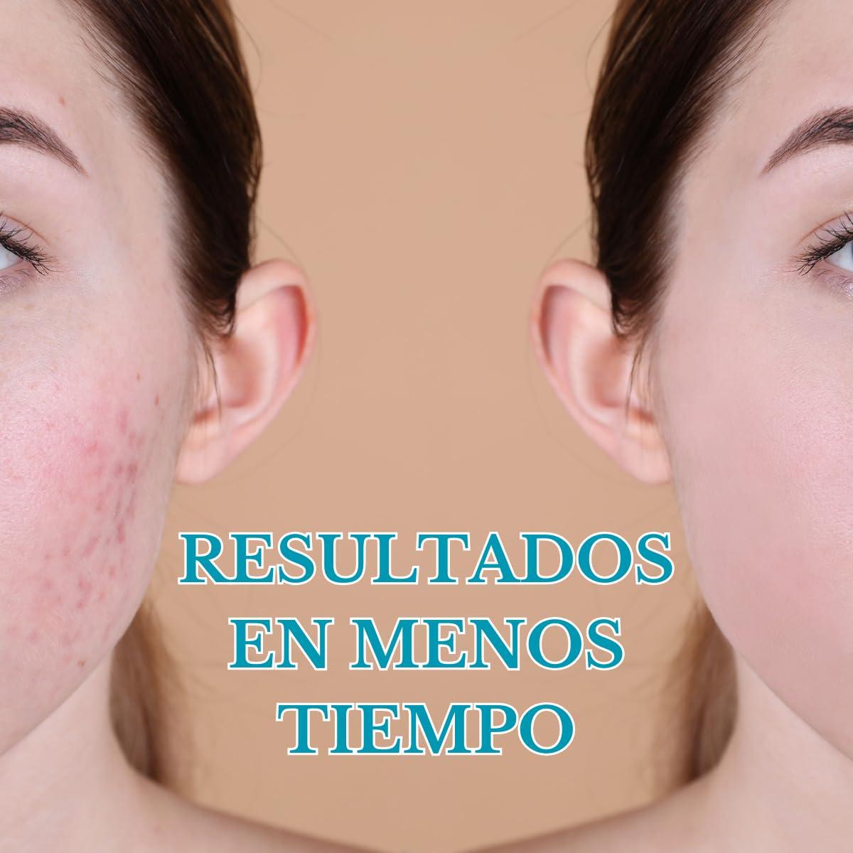 Bella Piel PINK MOSQUETTE ANTI-ACNE CREAM