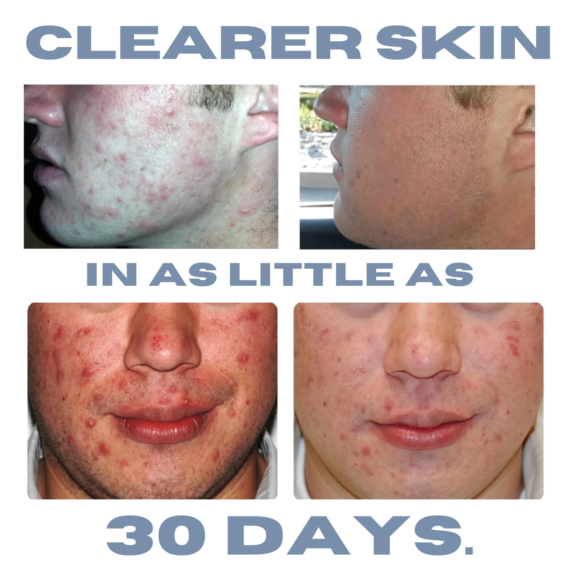 Clearogen Clearogen Hormonal Acne Solution Natural Anti-DHT Deluxe Set, 2-Month Sensitive Skin Kit