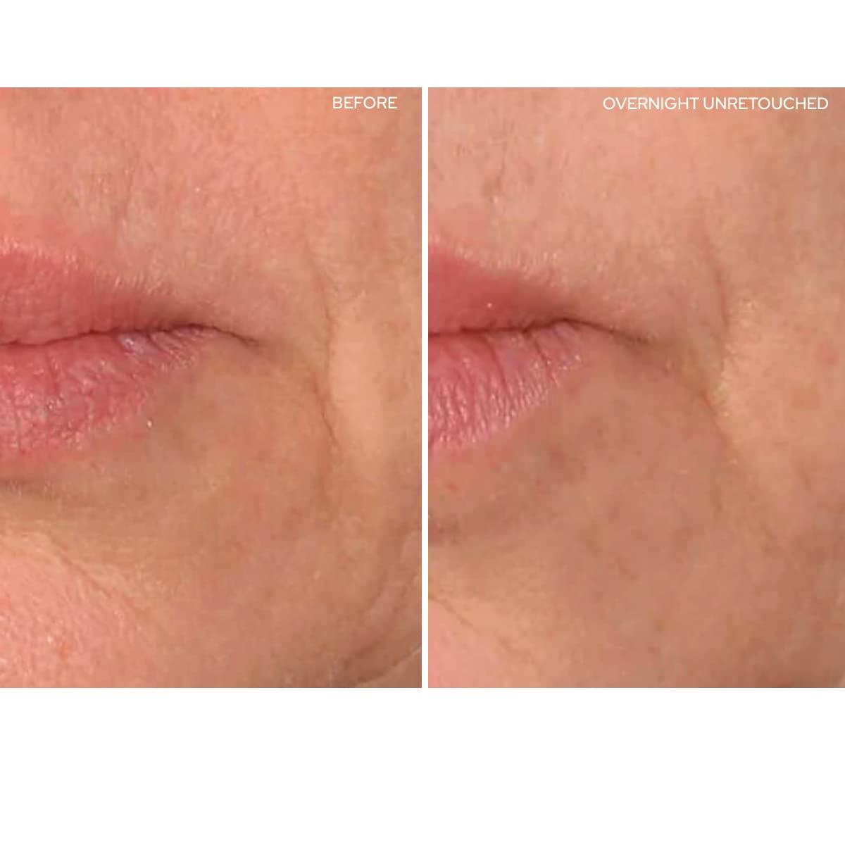 SiO SiO Beauty Eye and Smile SuperLift - Eye & Lip Anti-Wrinkle Silicone Patches - Reduce Smile and Under Eye Wrinkles Overnight