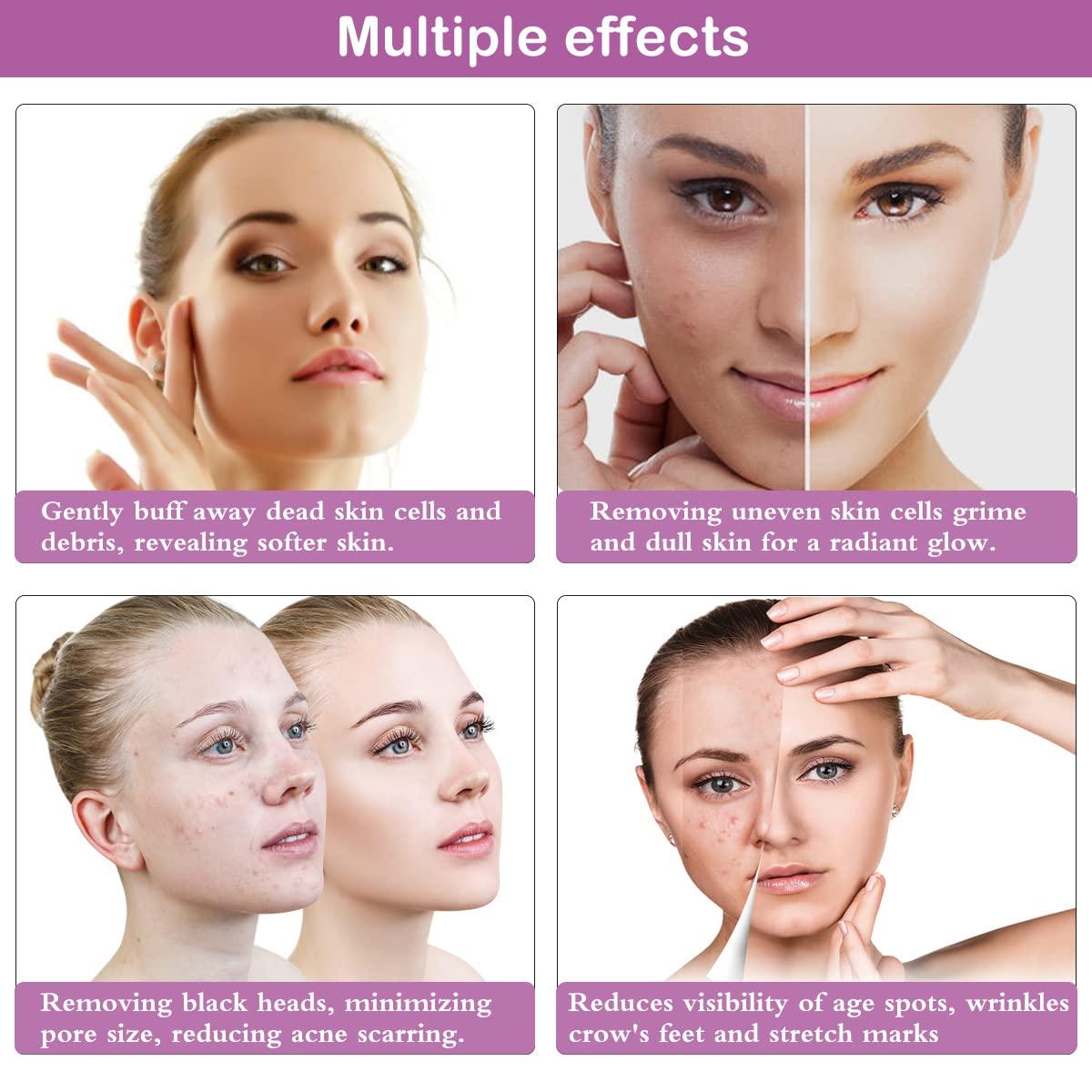 Yofuly Yofuly Diamond Microdermabrasion Machine, 65-68cmHg Suction Power Professional Dermabrasion, Home Use Facial Skin Care Equipment