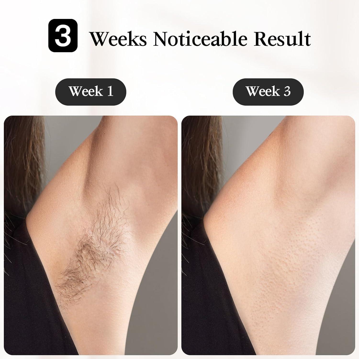 JOVS JOVS Laser Hair Removal, [24J Energy] IPL Hair Removal for Women and Men, 37F Painless Sapphire Ice-Cooling Tech, 6 Modes for Whole Body Hair Removal Device, 2 in 1 Skin Rejuvenation, 330 Rotation