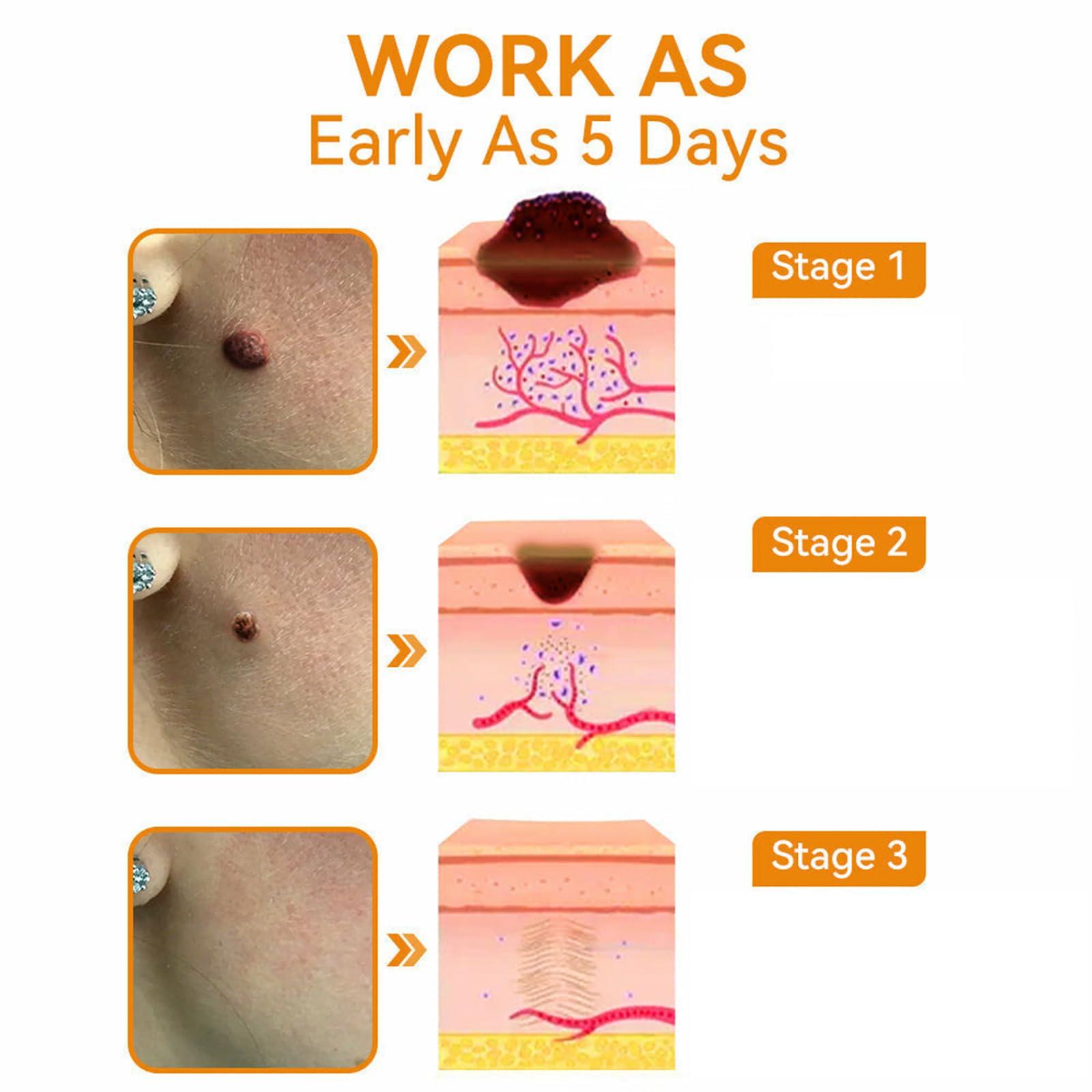 TLOPA TLOPA Bee Venom Treatment Cream, New Bee Venom Repair and Removing Cream,Hydrating Moisturizing Treatment cream for Men&Women,1Fl Oz (4)