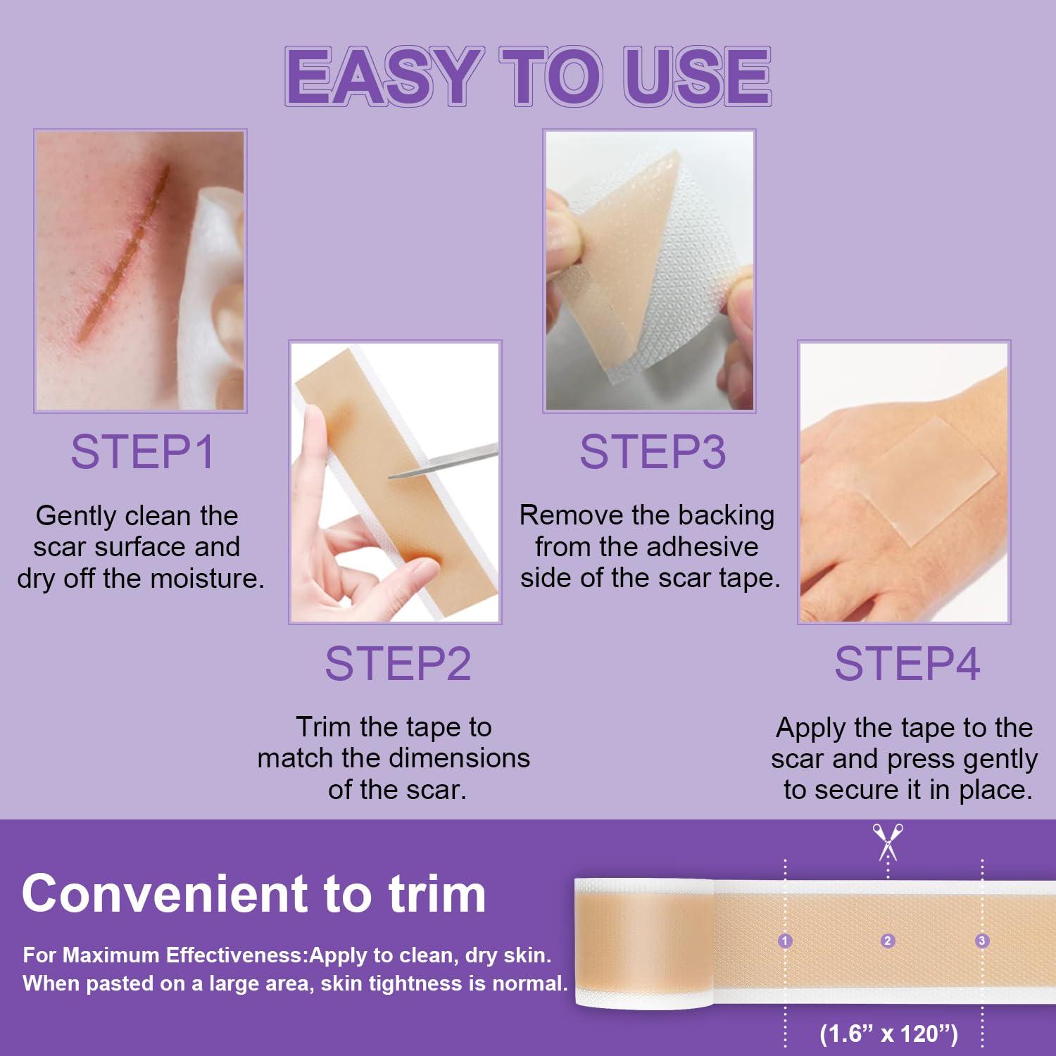 Mitgary Silicone Scar Sheets, Medical Grade Silicone Scar Tape (1.6\" x 120\"), Professional Scar Removal Treatment, Reusable, for Healing Keloids, Surgeries Scars, C-sections, and Burns