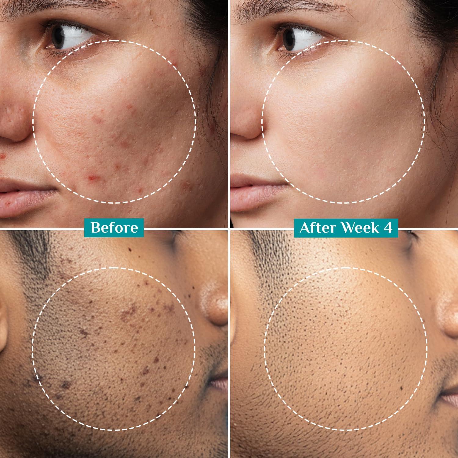 Pilgrim Pilgrim Korean Vitamin C Face Serum | with 2% Alpha Arbutin & Blueberry | Anti Aging Facial Serum | Reduce Dark Spots | Improves Skin Tone & Texture | 1.01 Fl Oz/30ml