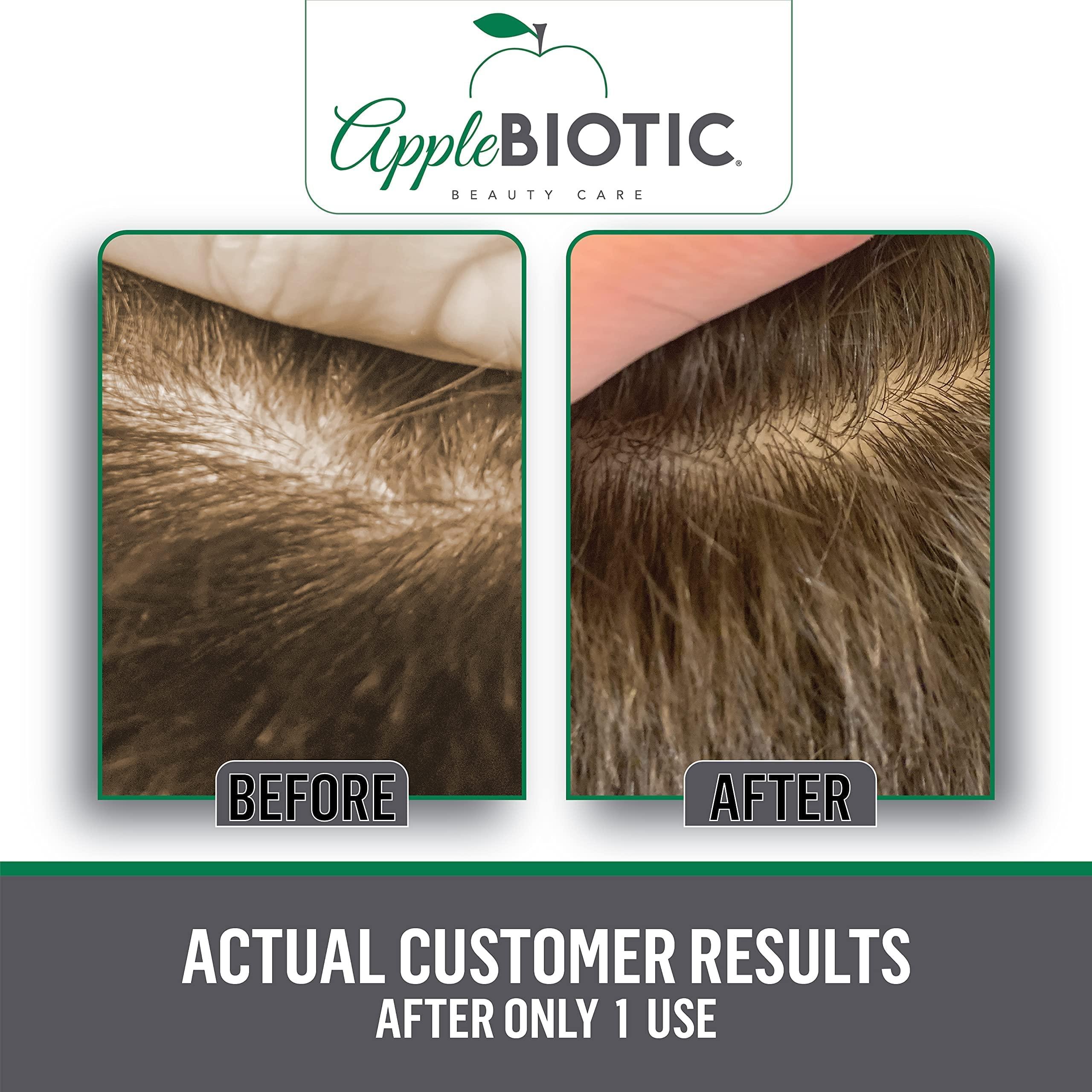 AppleBiotic Apple Cider Vinegar Scalp Scrub 2PK - Exfoliating Scalp Treatment with Coconut & Sesame Seed Oils - Moisturizes & Relieves Itchy, Flaky Skin. Hair Scrub & Scalp Cleanser for Build Up, Healthy Hair