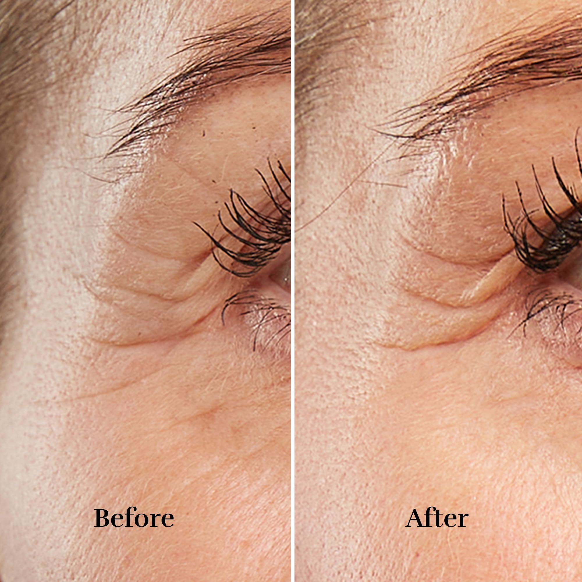 Silk\'n Silkn Anti-Aging Device | Titan Mini | Wrinkle Reduction & Skin Tightening | Rejuvenates Skin on Smaller Face Areas | Cordless Use | Skin Care Device with LED | Unisex Hygiene & Personal Care