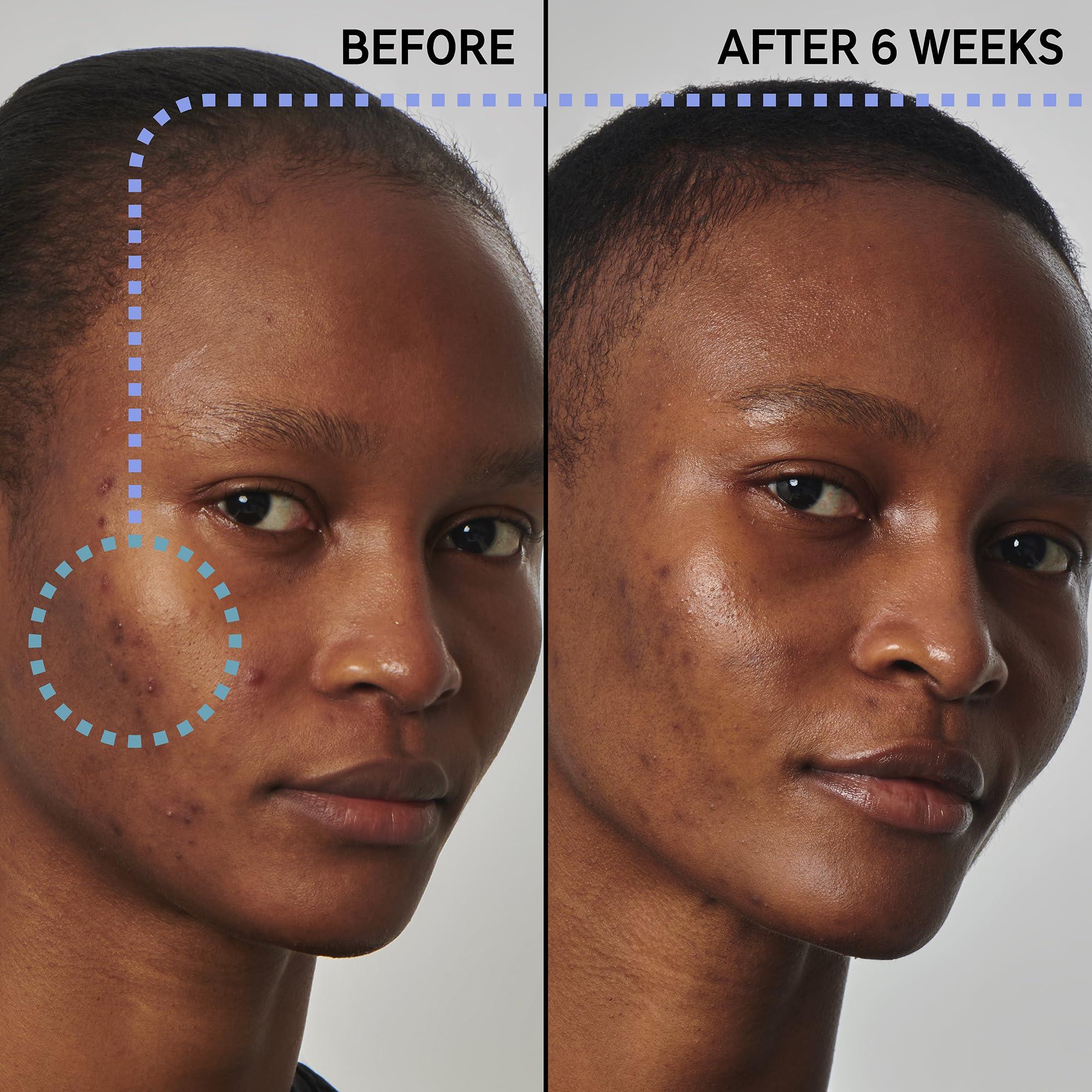 The INKEY List The INKEY List SuperSolutions Niacinamide 20% Serum, Helps with Healthy-Looking Skin Texture, Pores and Balancing Excess Oil, Skin Barrier Protection 1.01 fl oz