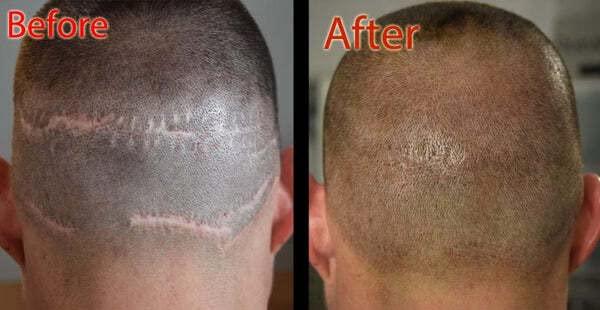 DermiMatch LLC HD-B - SMP Scalp pigment - Half Oz