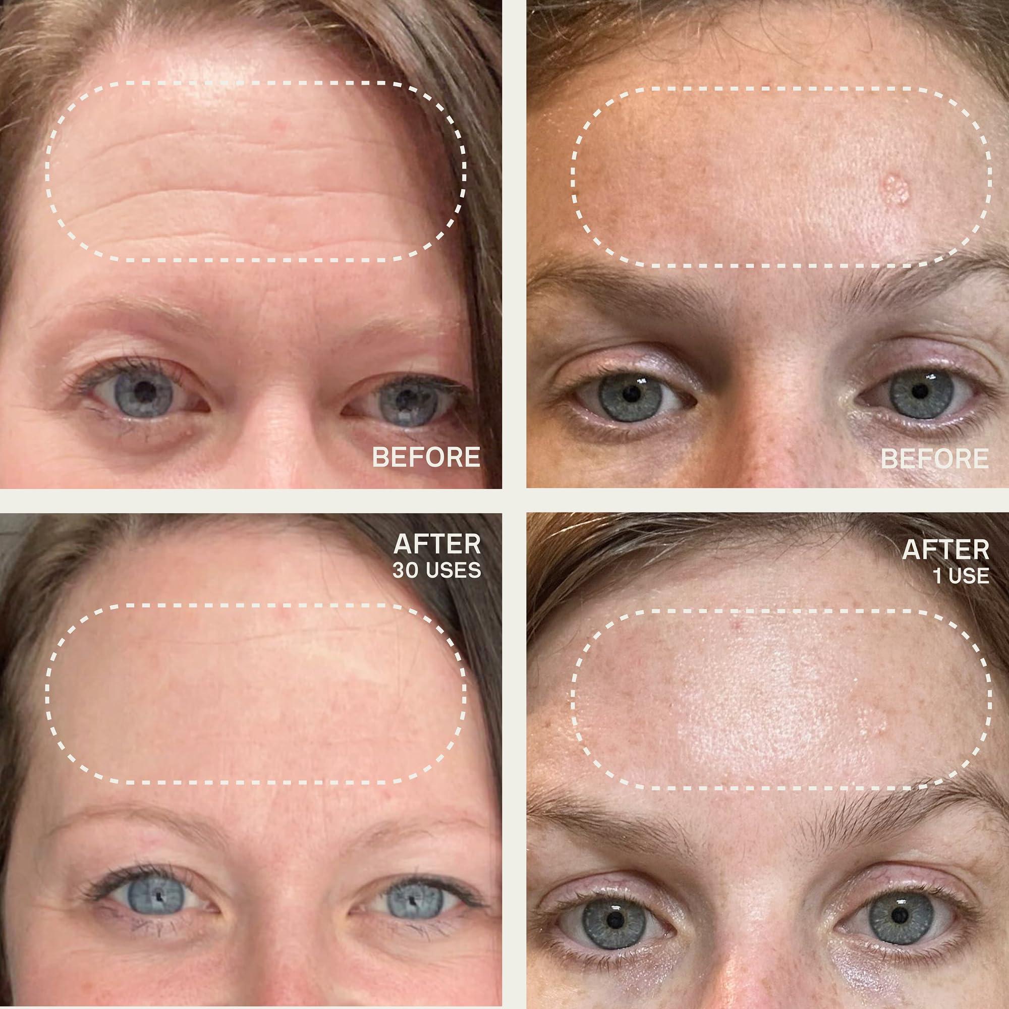 Dermaclara Dermaclara Silicone Facial Patches - Anti-Wrinkle Face Patches for Frown, Smile Lines & Forehead, Reusable Overnight Silicone Wrinkle Pads, Up to 30 Uses - 4 Under Eye Patches & 1 Forehead Patch