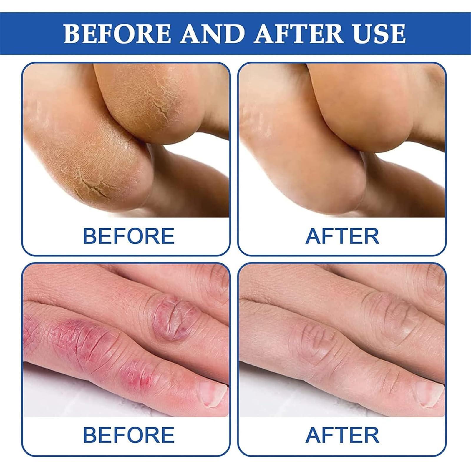 DRXVE DRXVE Chilblain Cream, Anti-cracking Frostbite Moisturiser Deep Nourishing, Anti Crack & Hand Foot Cream, Foot Repair Cream, for Dry Cracked Heels Callus Remover (2 Pc)