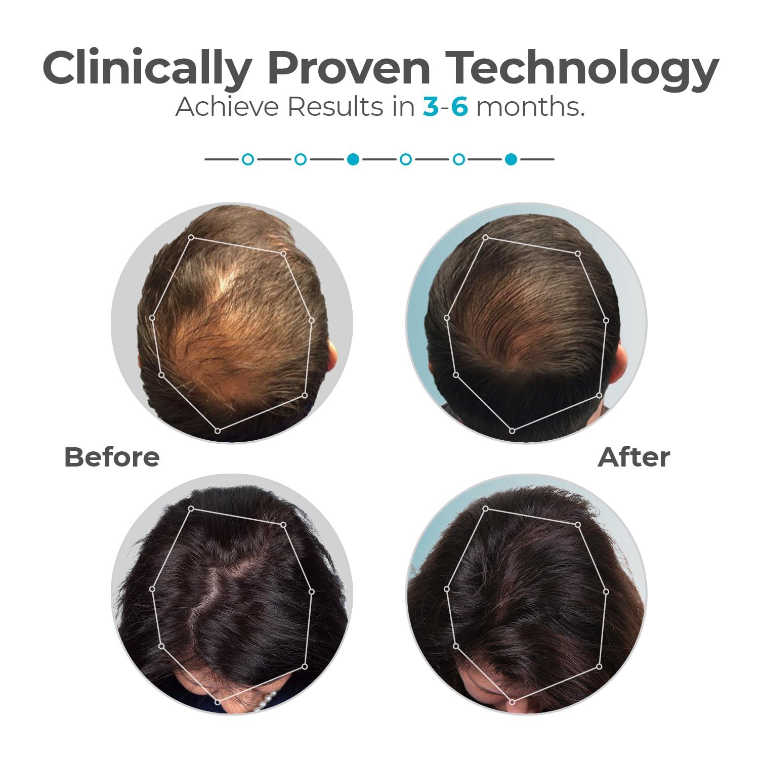 Capillus Capillus Plus Mobile Laser Therapy Cap for Hair Regrowth, with 202 Red Light Lasers for Laser Hair Growth, Red Light Hair Growth