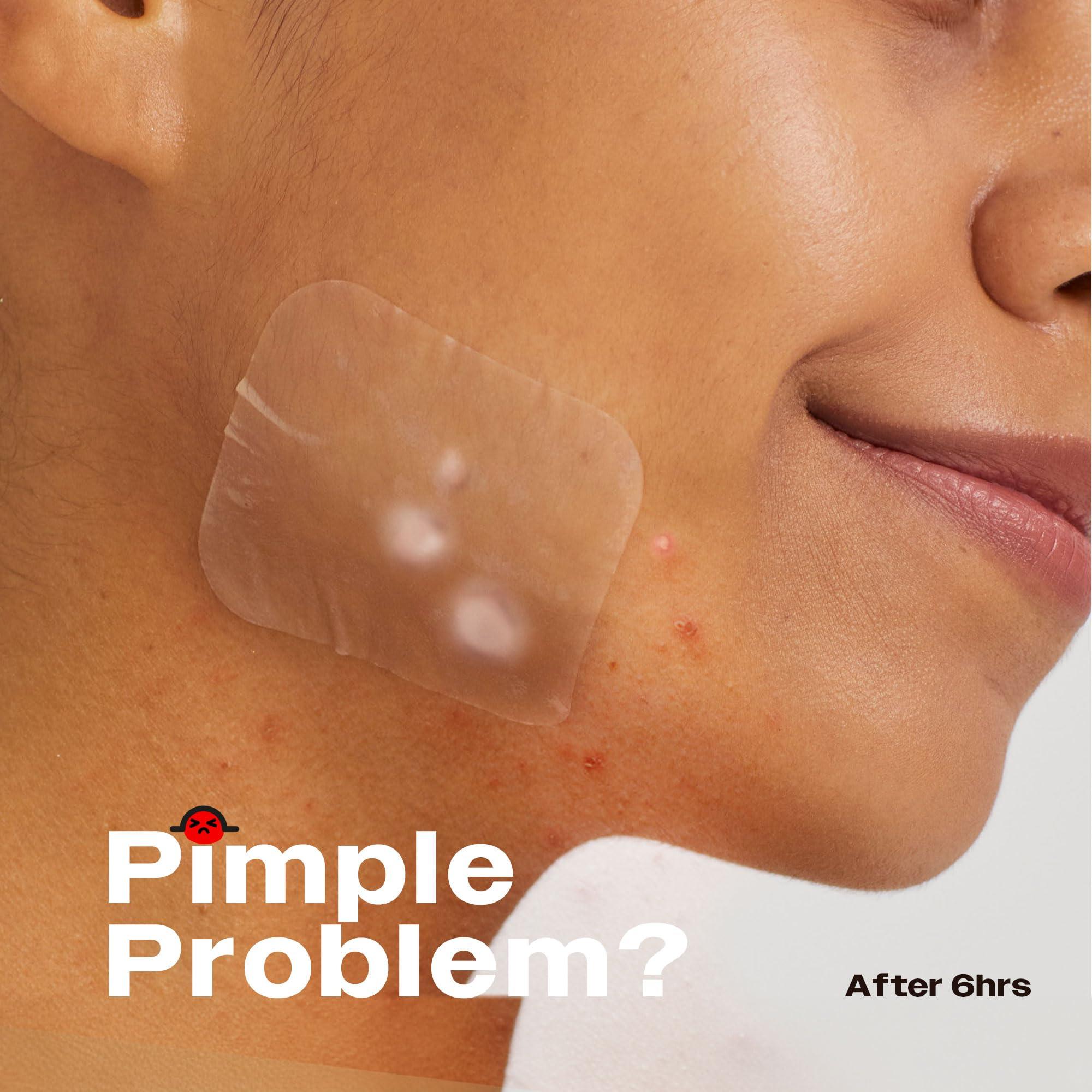 AVARELLE AVARELLE Acne Patches XL, FSA HSA Acne Patch Large | Pimple Patches for Face Cheek & Nose (8 Count) | Large Hydrocolloid Acne Treatment with Tea Tree, Calendula, & Cica by ZITOUT