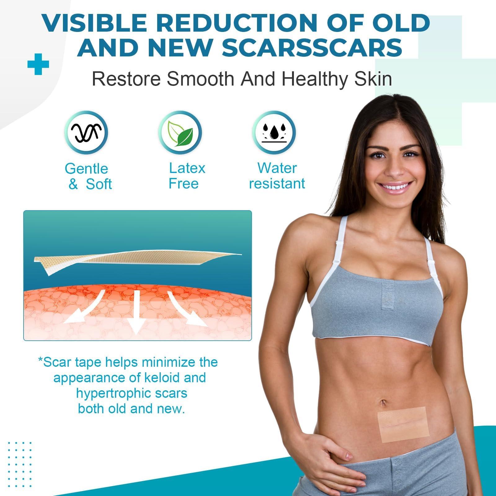 Rvlaim Silicone Scar Sheets, Silicone Scar Tape(1.6x 120 Roll-3M), Silicone Scar Strips, Professional Scar Removal Sheets for Surgical Scars, Keloid, C-Section, Burn et