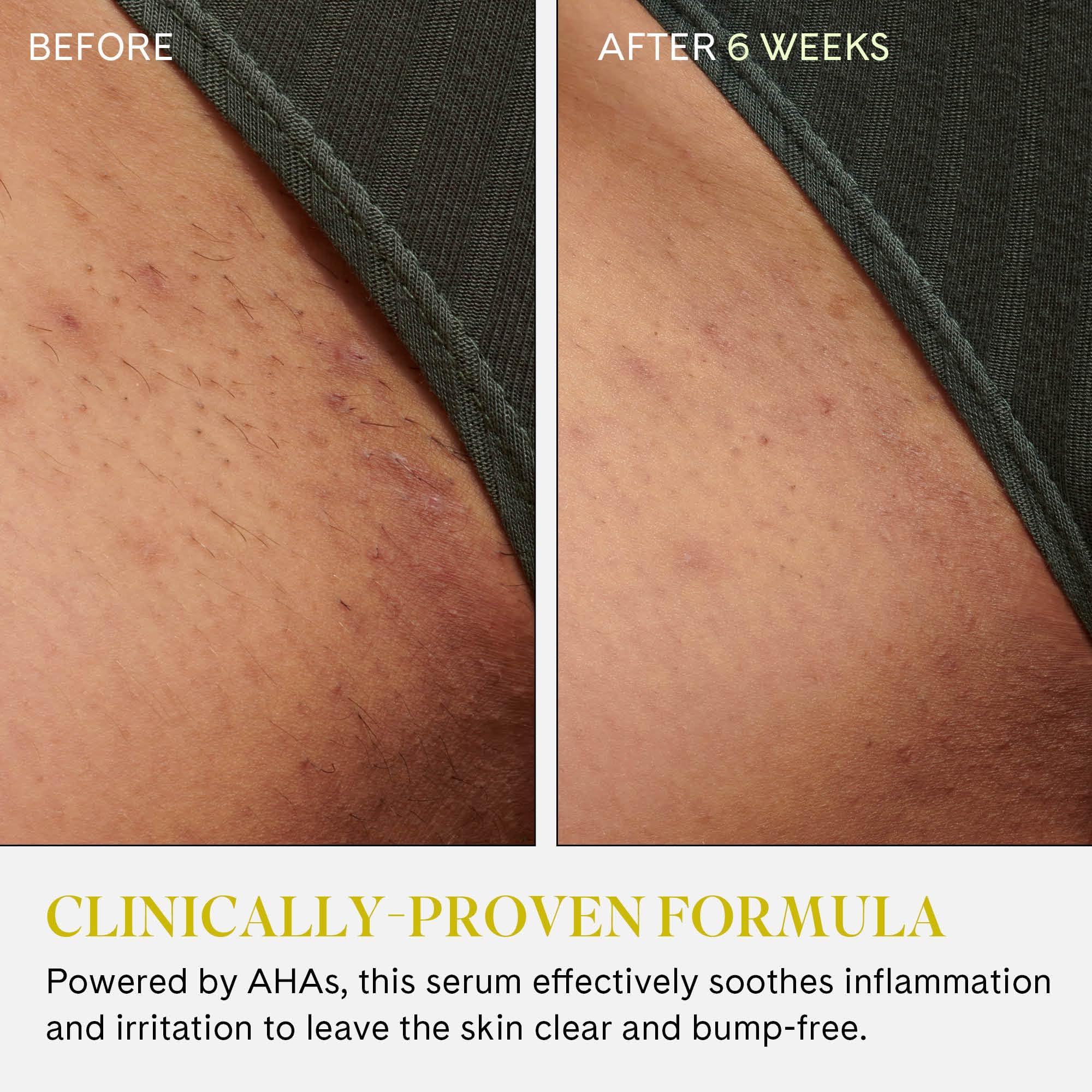 Fur Fur Ingrown Eliminator Serum Rollerball Travel Size - Powerful Ingrown Hair Treatment Serum With AHAs and BHAs to Treat and Prevent Ingrown Hairs and Bumps, Hydrates and Soothes Irritated Skin - 10 ml