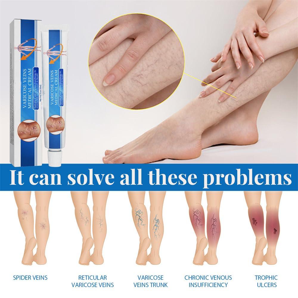 Nosbei Vericose Veins Treatment Blue Light Lazer Treatment Pen, Varicose Veins Blue Light Therapy Set, Blue Light Therapy Pen for Varicose and Spider Veins, Spider Vein Removal Lazer Pen (2cream+1pen)