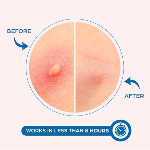 KEYCONCEPTS PatchRx Pimple Patches for Face (120 Patches), Hydrocolloid Acne Patches with Tea Tree Oil, Pimple Patch Pimple Stickers - Hydrocolloid Patch Acne Dots - Acne Pimple Patches For Face - Zit Patches