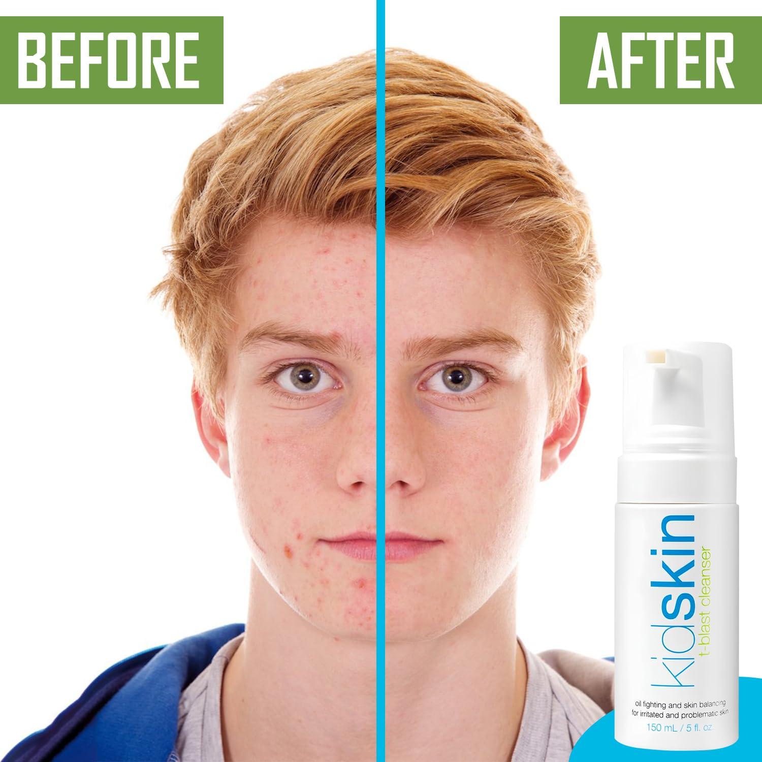 Kidskin Kidskin T-Blast Facial Cleanser, Gentle Face Wash with Tea Tree Oil, Spot Skin Care for Kids and Teens, Non-Drying Natural Cleanser for Oily or Dry, Acne-Prone Skin, 150 ml 5.0 fl oz.