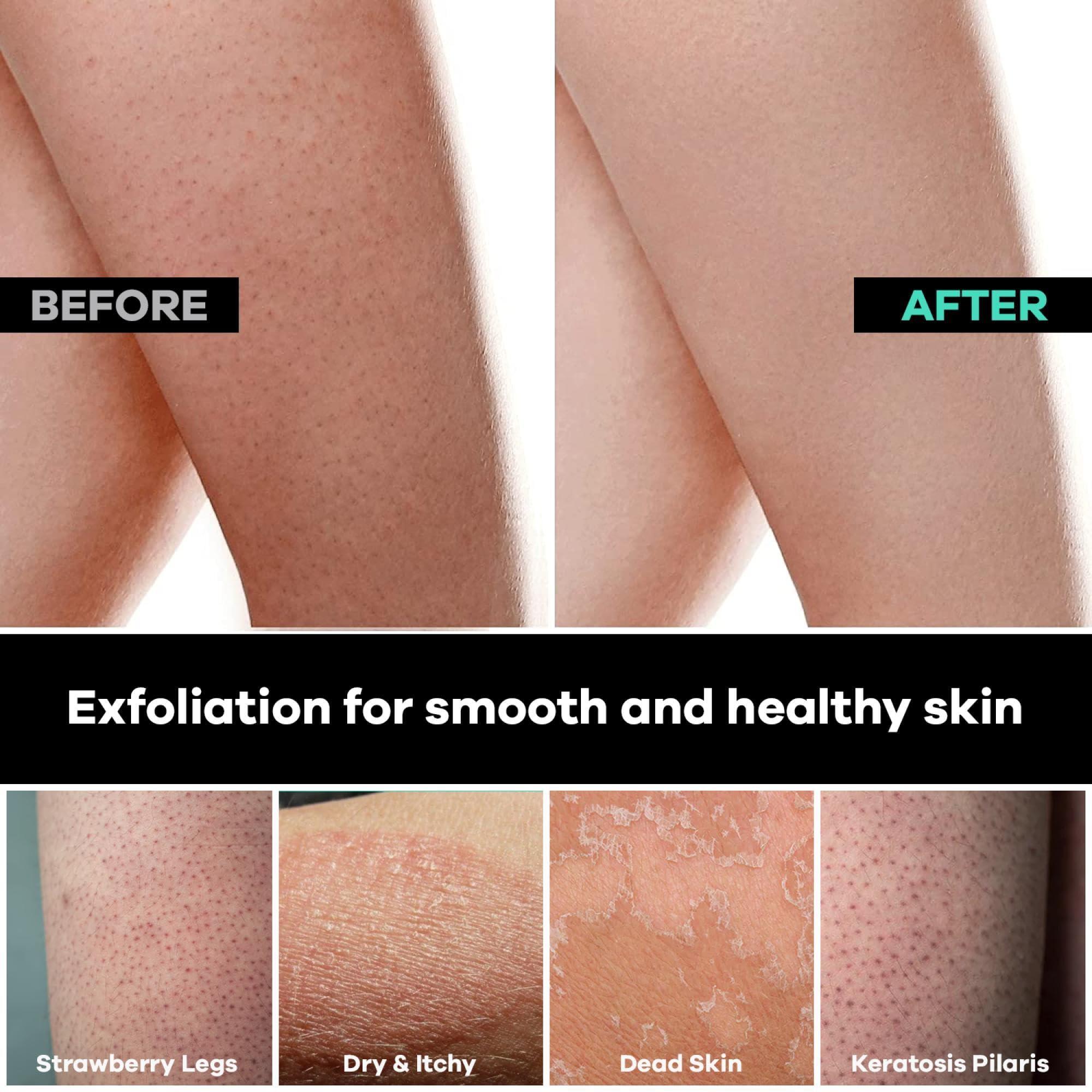 Dermasuri Dermasuri Deep Exfoliating Glove for Shower - Scrubbing Mitt Body Scrubber Gloves Skin Exfoliator & Eliminates Dead Skin - Keratosis Pilaris Scrub Spray Tan Remover - Korean Skincare for Body (2 Pack)