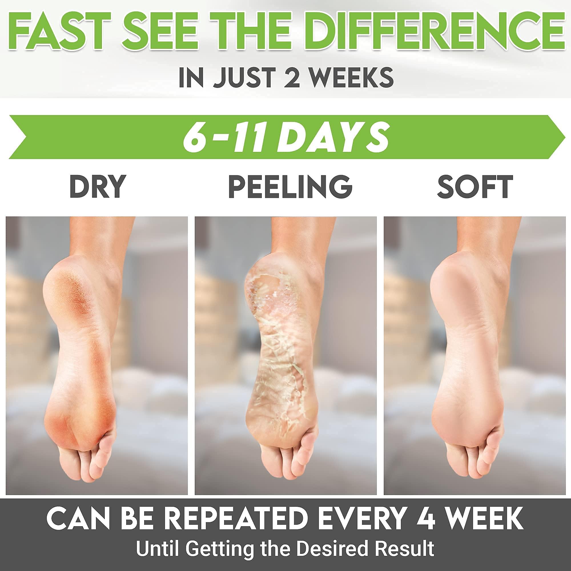 karma organic Foot Peel Mask Green Tea Moisturizing Exfoliating Foot Masks - Karma Organic Feet Peeling Masks for Dry ed Feet, Remove Dead Skin & Calluses - Removes & Repairs Rough Heels, Dry Toe Skin (Pack of 2)